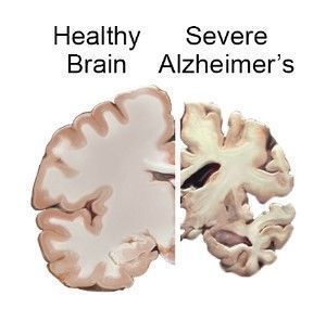Alzheimer’s Disease from Octopus Saliva New Health Benefits post thumbnail image